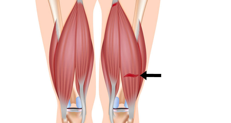 Hamstring Injury: Causes, Recovery, and Prevention